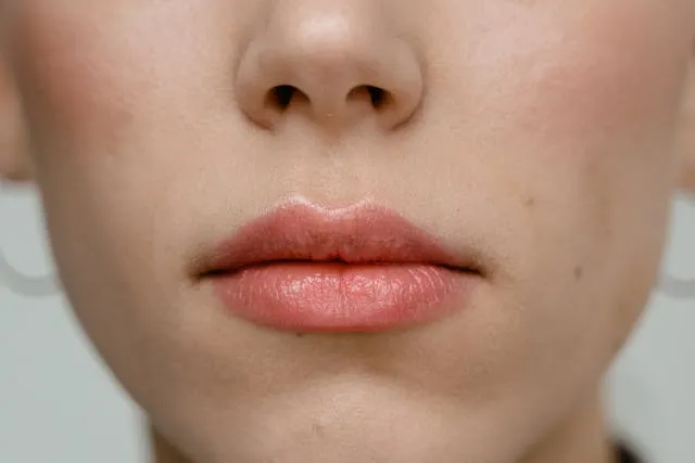 Laser Lip Depigmentation